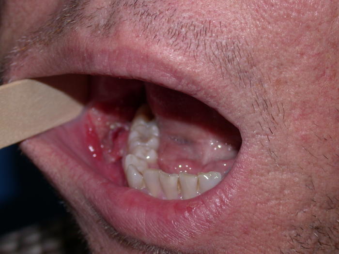 Squamous Cell Carcinoma. Squamous Cell Carcinoma.